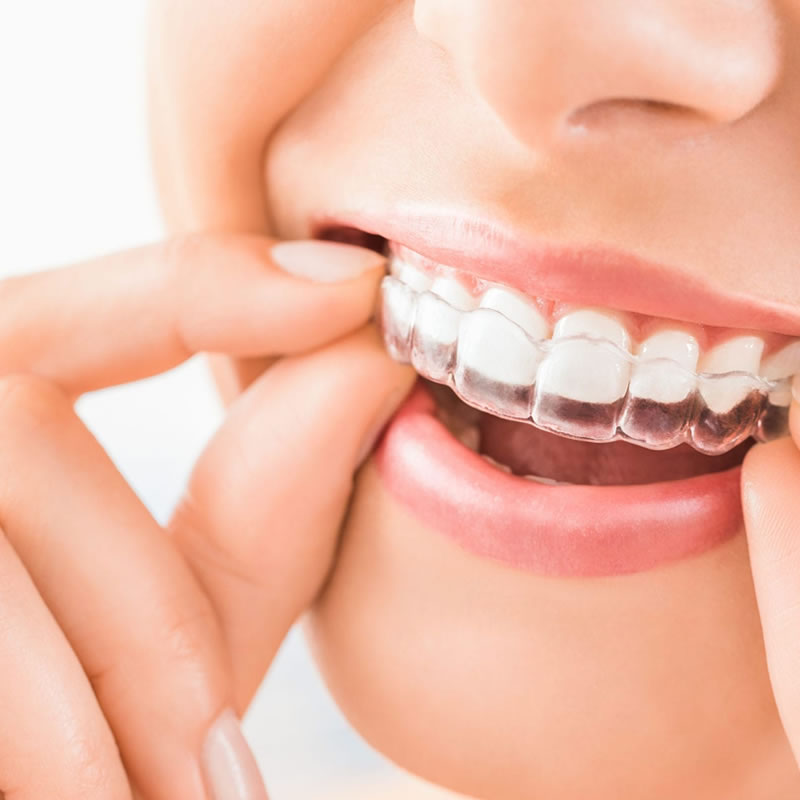 Invisalign – Invisible Braces - Total Smiles Dentistry Richmond Virginia